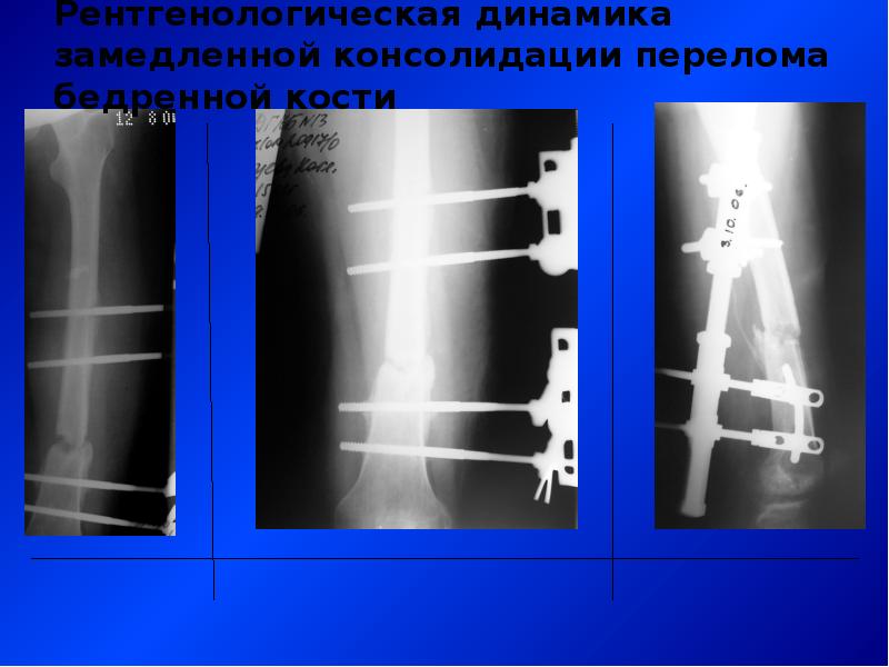 Замедленная консолидация презентация