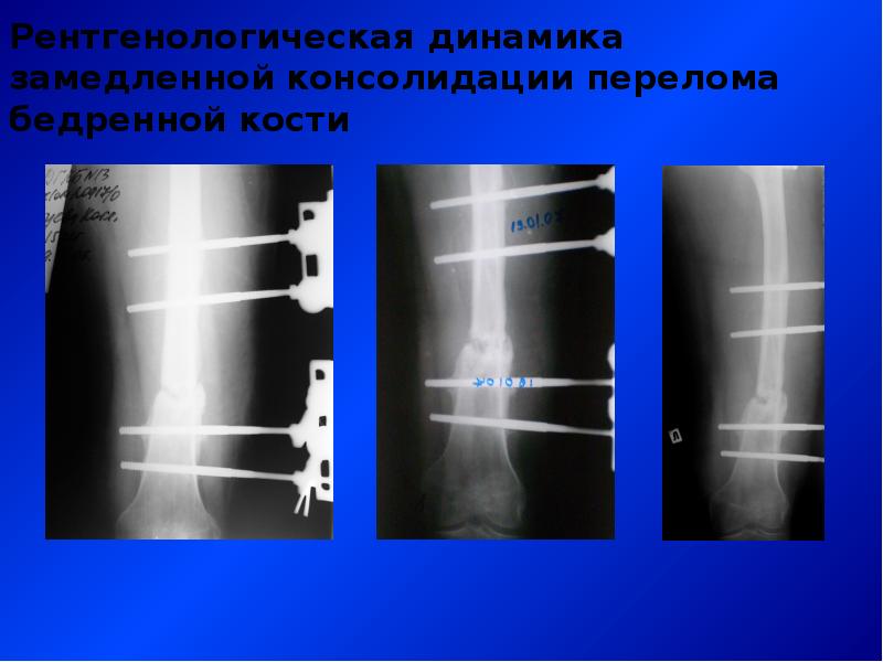 Консолидация перелома. Замедленная консолидация переломов рентген. Стадии консолидации перелома на рентгене. Степень консолидации перелома рентген. Замедленной консолидации отломков.