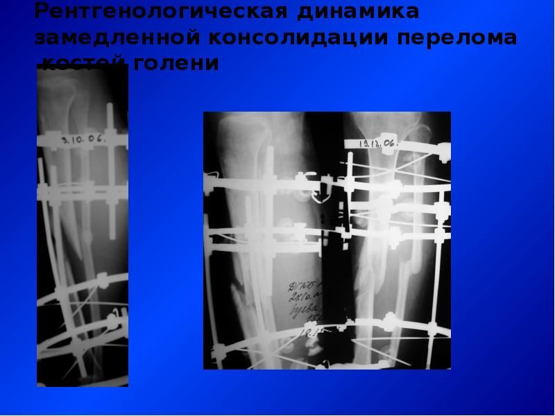 Что такое консолидация перелома. Степень консолидации перелома рентген. Рентген признаки замедленной консолидации. Замедленная консолидация переломов рентген. Консолидация переломов костей.