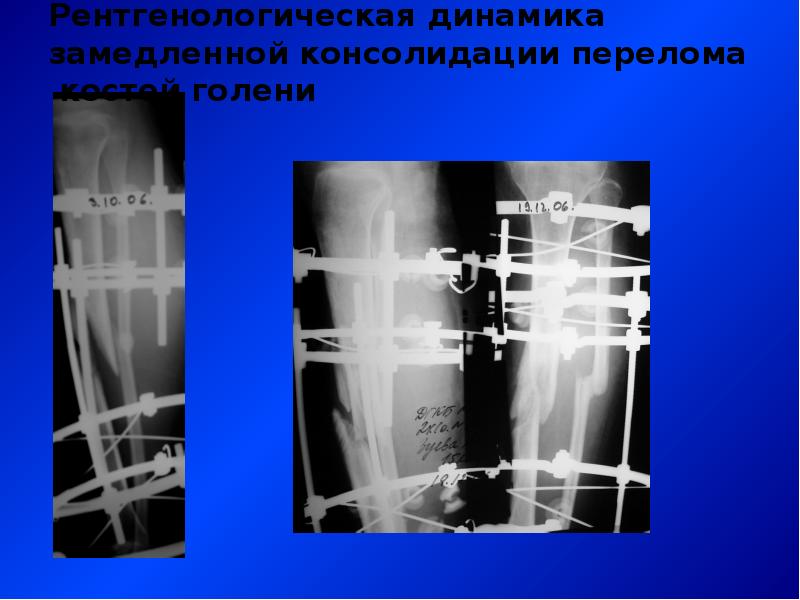 Консолидирующий перелом. Степень консолидации перелома рентген. Рентген признаки замедленной консолидации. Замедленная консолидация переломов рентген. Консолидированный перелом.