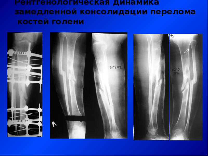 Презентация перелом костей голени