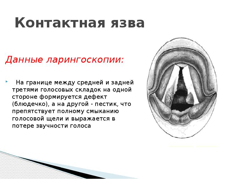 Мышцы расширяющие голосовую щель. Мышцы расширяющие голосовую щель