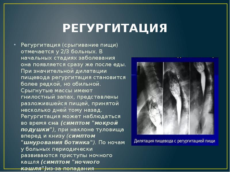 РЕГУРГИТАЦИЯ
Регургитация (срыгивание пищи) отмечается у 2/3 больных. В начальных стадиях РЕГУРГИТАЦИЯ
Регургитация (срыгивание пищи) отмечается у 2/3 больных. В начальных стадиях