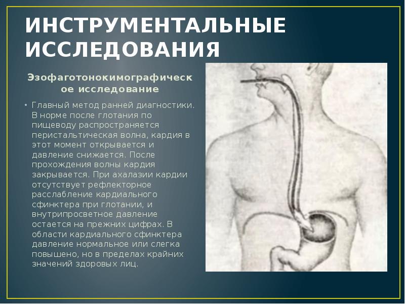 Недостаточность кардии желудка симптомы