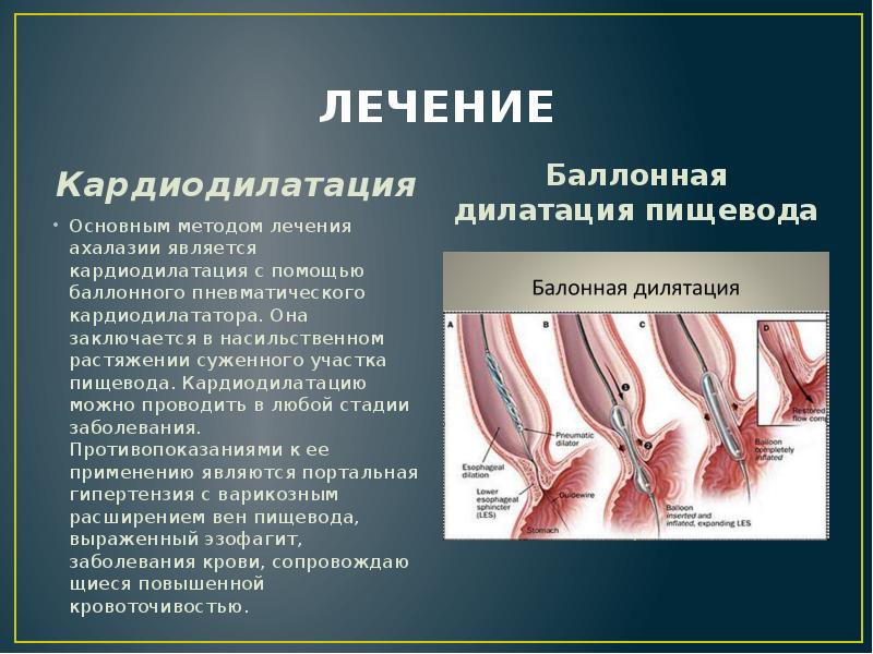 Ахалазии кардии презентация