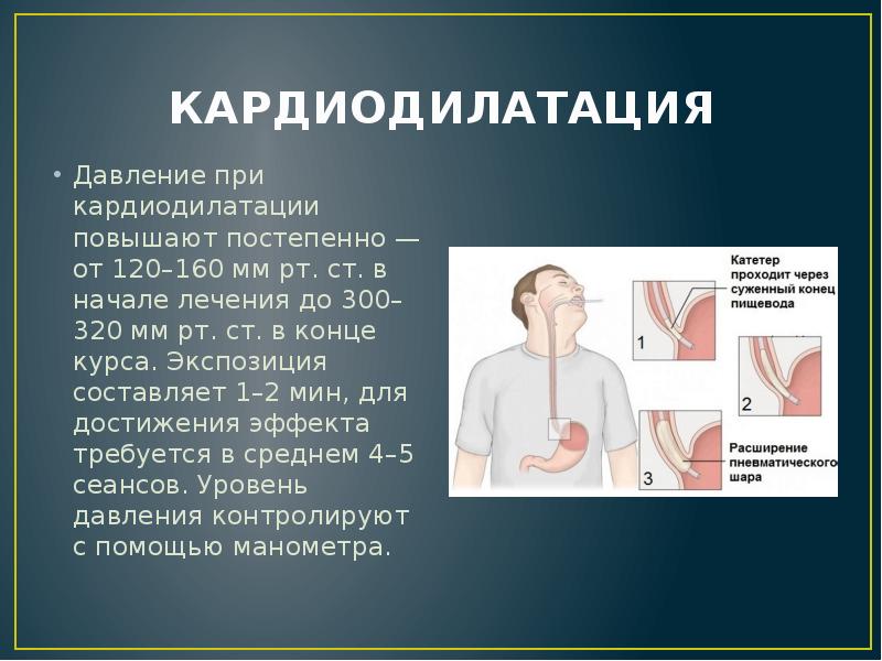 КАРДИОДИЛАТАЦИЯ
Давление при кардиодилатации повышают постепенно — от 120–160 мм рт. КАРДИОДИЛАТАЦИЯ
Давление при кардиодилатации повышают постепенно — от 120–160 мм рт.