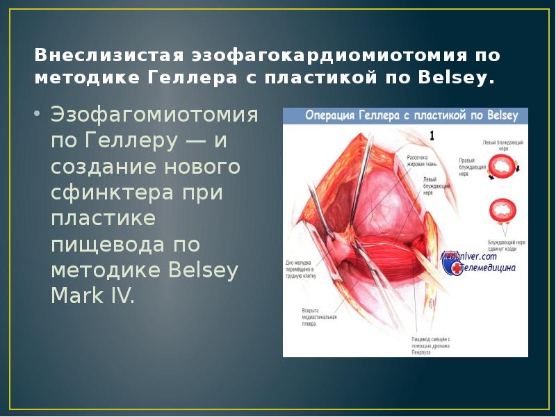 Внеслизистая эзофагокардиомиотомия по методике Геллера с пластикой по Belsey.
Эзофагомиотомия по Внеслизистая эзофагокардиомиотомия по методике Геллера с пластикой по Belsey.
Эзофагомиотомия по