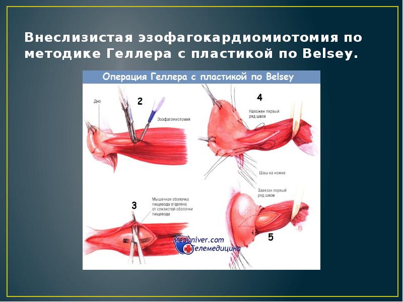 Внеслизистая эзофагокардиомиотомия по методике Геллера с пластикой по Belsey. Внеслизистая эзофагокардиомиотомия по методике Геллера с пластикой по Belsey.