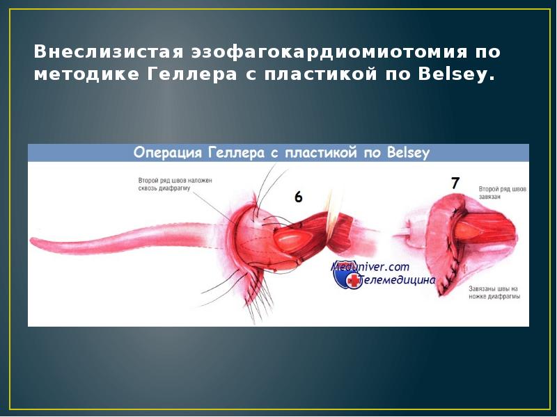 Внеслизистая эзофагокардиомиотомия по методике Геллера с пластикой по Belsey. Внеслизистая эзофагокардиомиотомия по методике Геллера с пластикой по Belsey.