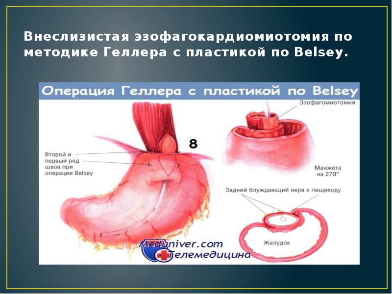 Внеслизистая эзофагокардиомиотомия по методике Геллера с пластикой по Belsey. Внеслизистая эзофагокардиомиотомия по методике Геллера с пластикой по Belsey.