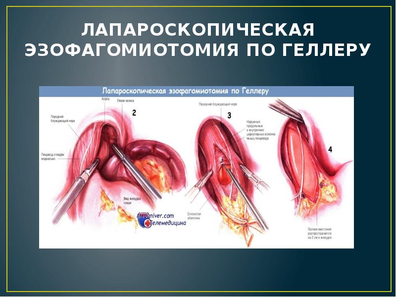 ЛАПАРОСКОПИЧЕСКАЯ ЭЗОФАГОМИОТОМИЯ ПО ГЕЛЛЕРУ ЛАПАРОСКОПИЧЕСКАЯ ЭЗОФАГОМИОТОМИЯ ПО ГЕЛЛЕРУ