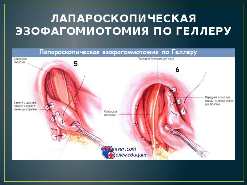 ЛАПАРОСКОПИЧЕСКАЯ ЭЗОФАГОМИОТОМИЯ ПО ГЕЛЛЕРУ ЛАПАРОСКОПИЧЕСКАЯ ЭЗОФАГОМИОТОМИЯ ПО ГЕЛЛЕРУ