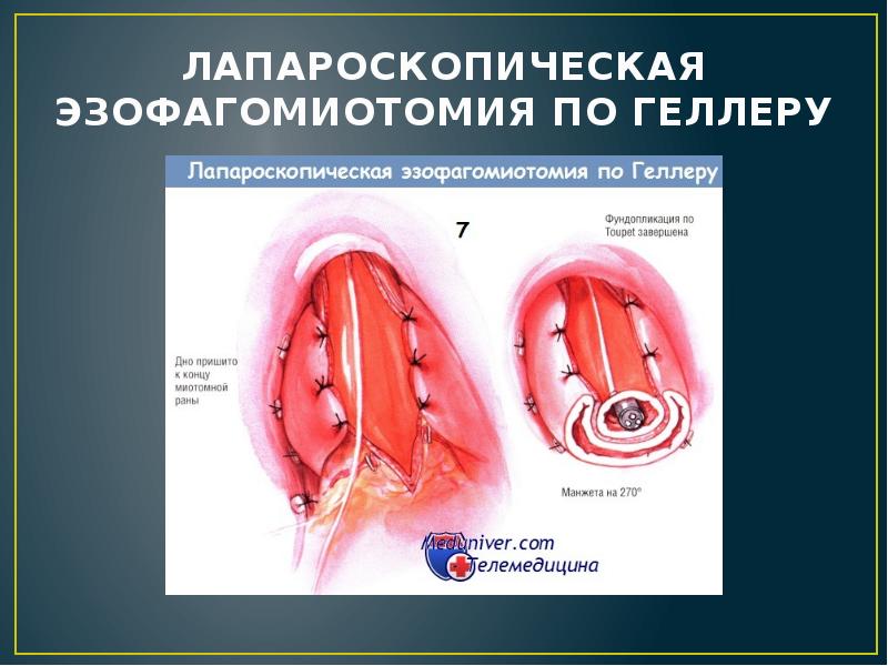 ЛАПАРОСКОПИЧЕСКАЯ ЭЗОФАГОМИОТОМИЯ ПО ГЕЛЛЕРУ ЛАПАРОСКОПИЧЕСКАЯ ЭЗОФАГОМИОТОМИЯ ПО ГЕЛЛЕРУ