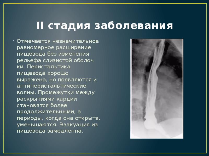 Ахалазии кардии презентация