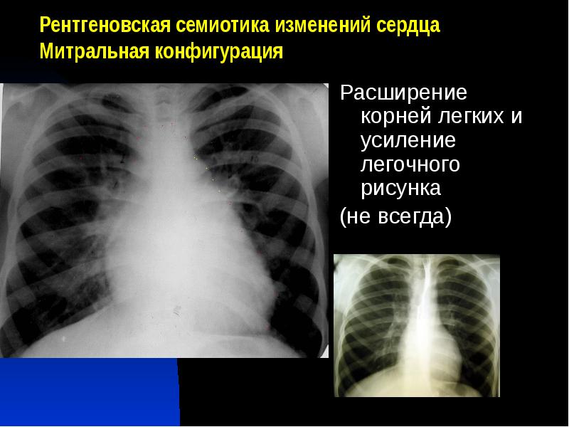 Усиление легочного рисунка расширение корней легких