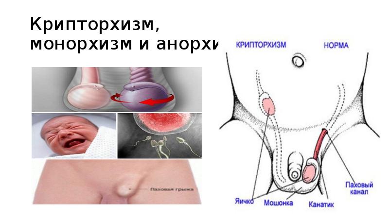 Крипторхизм презентация детская хирургия