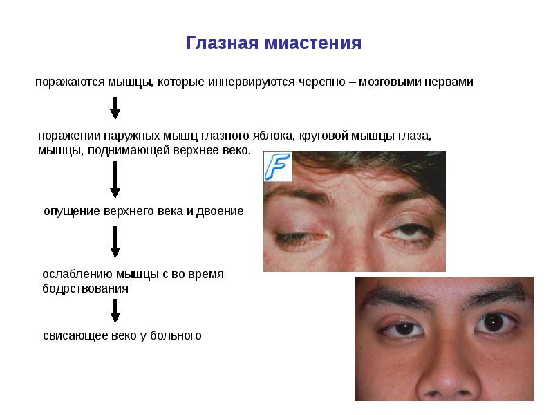 Миастения презентация неврология