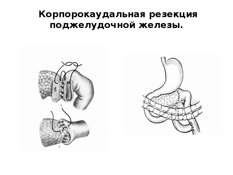 Резекция поджелудочной железы схема