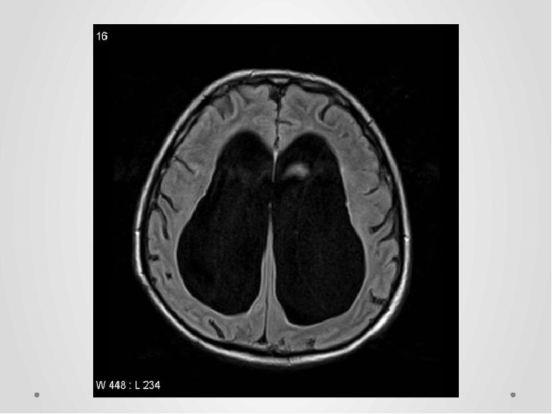 Мр картина умеренной наружной гидроцефалии что это