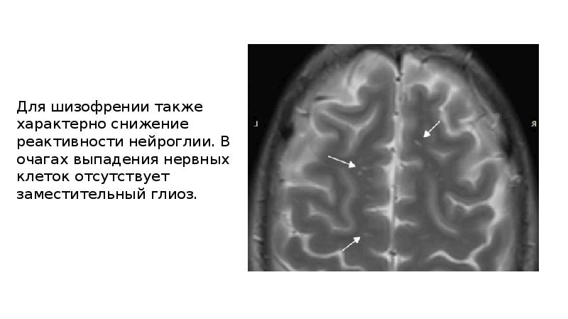 Мр картина единичных супратенториальных очагов глиоза микроангиопатия что это