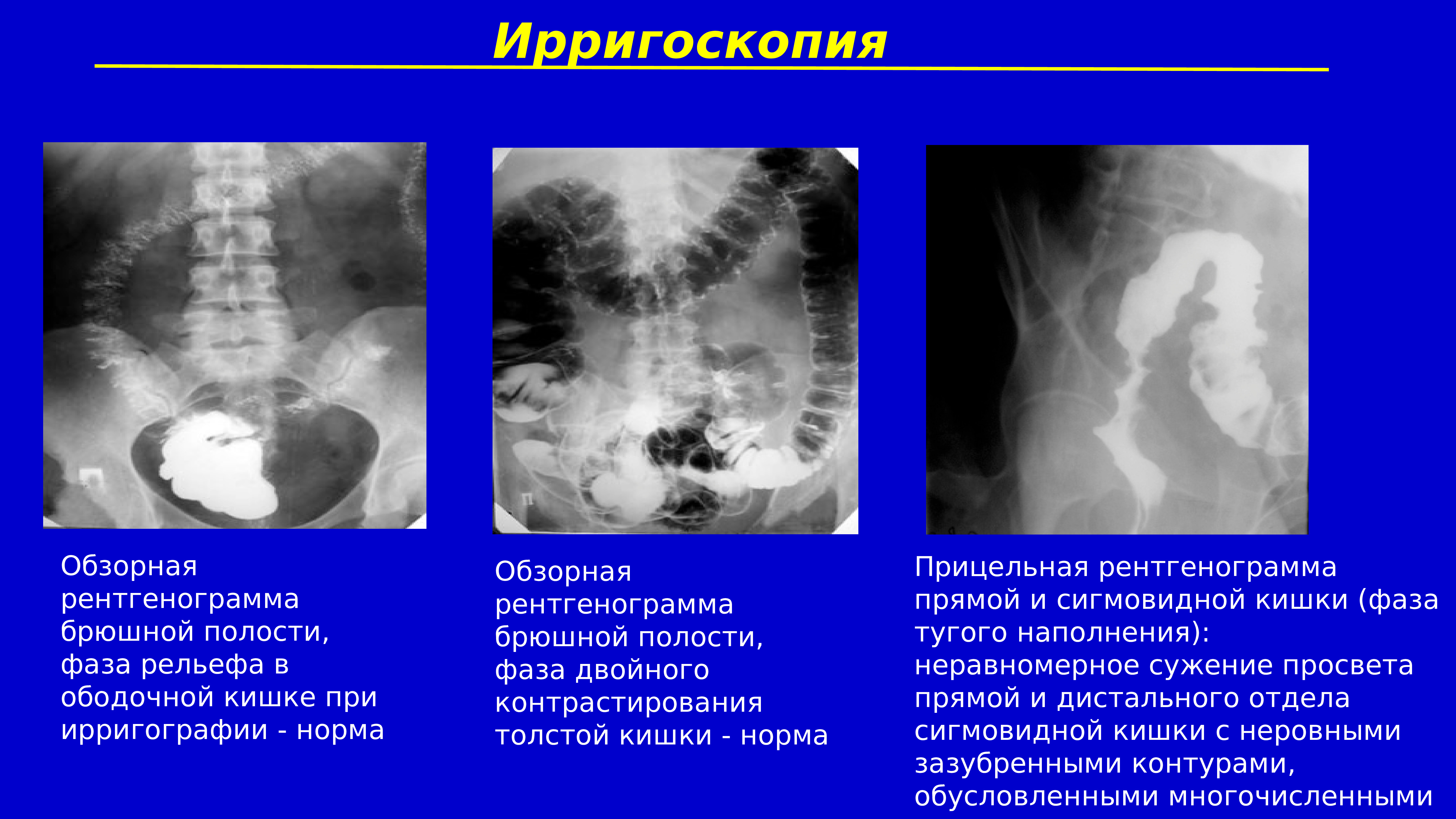 Полость нормально. Обзорный рентген брюшной полости норма. Прицельная рентгенограмма толстой кишки. Синдром раздраженного кишечника рентген. Ирригоскопия фаза тугого наполнения.