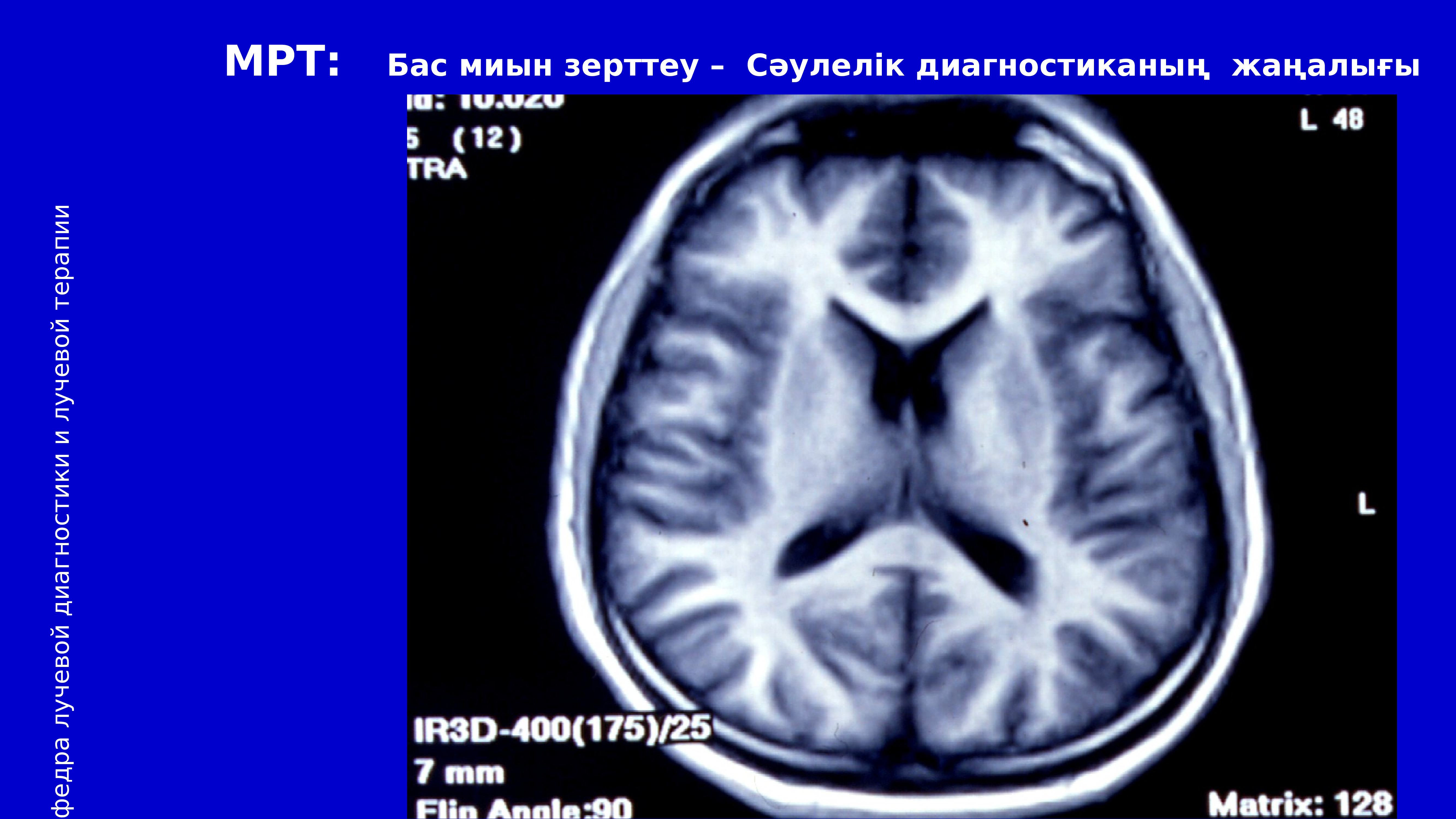 Исследование головного. Боковой амиотрофический склероз на мрт головного мозга. Бас на мрт мозга. Мрт при боковом амиотрофическом склерозе.