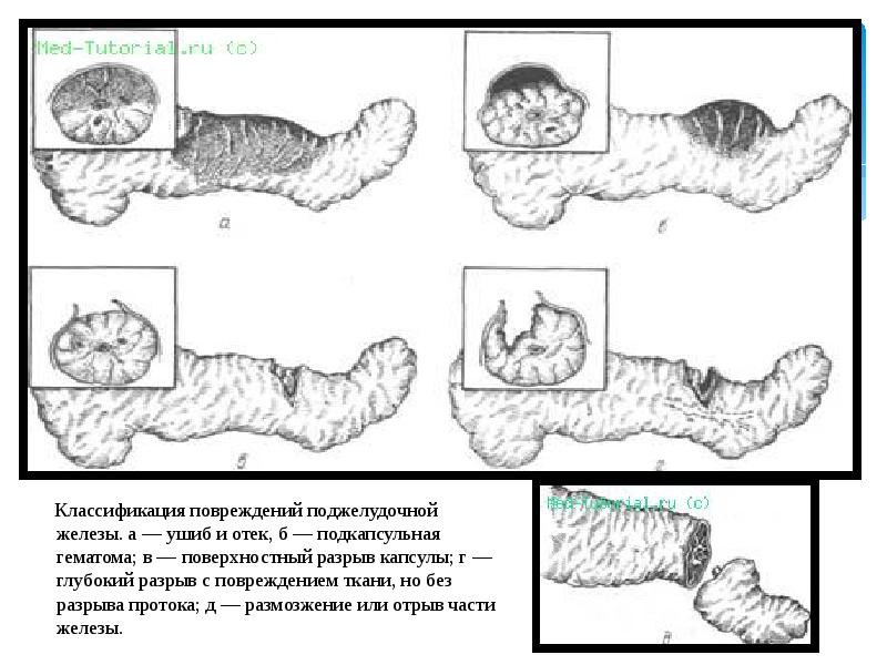 Повреждение поджелудочной железы презентация