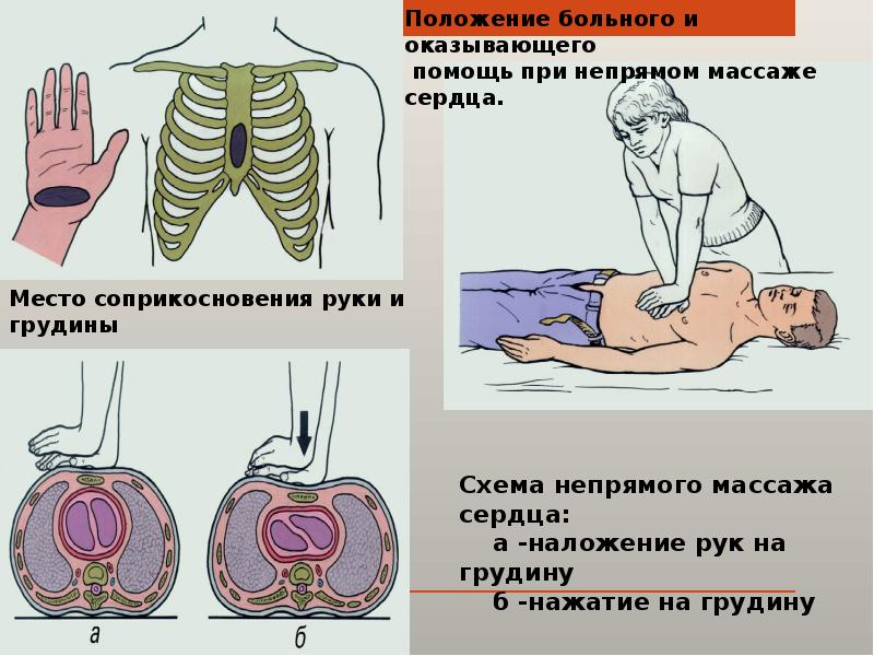 Частота надавливания при проведении компрессии грудной клетки. Непрямой массаж сердца алгоритм. Массаж сердца алгоритм. Непрямой закрытый массаж сердца алгоритм. Алгоритм наружного массажа сердца.