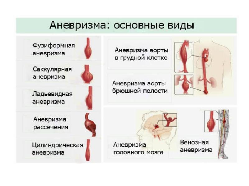Симптомы разрыва аневризмы. Типы аневризм брюшной аорты. Классификация аневризм сосудов. Аневризма брюшного отдела аорты типы. Классификация аневризмы брюшного отдела аорты.