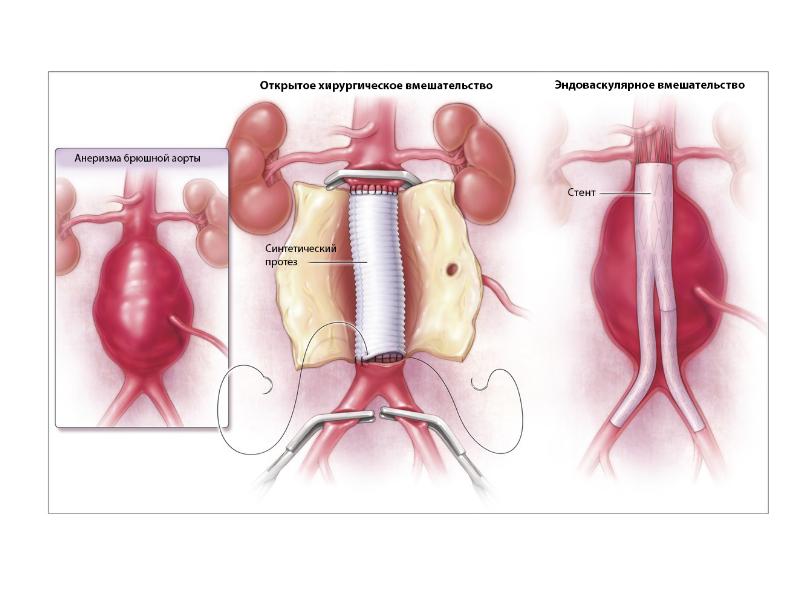 Аневризма брюшной аорты презентация
