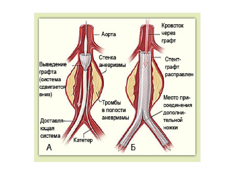 Аневризма брюшной аорты. Аневризма аорты презентация. Аневризмы аорты брюшной презентация. Аневризмы аорты презентация. Аневризма брюшной аорты презентация.