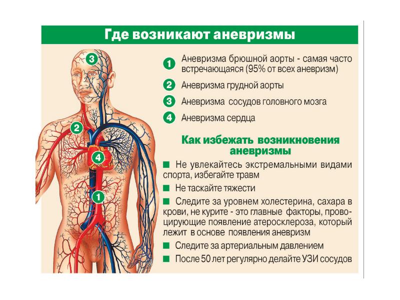 Аневризма брюшной аорты фото