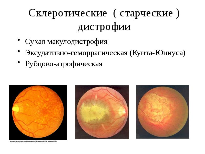 Возрастная макулодистрофия презентация