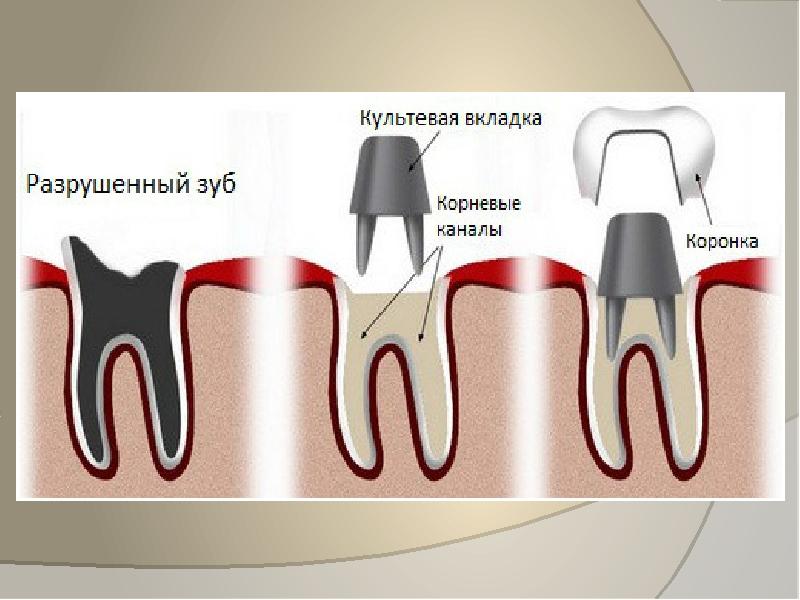 Презентация зубные вкладки