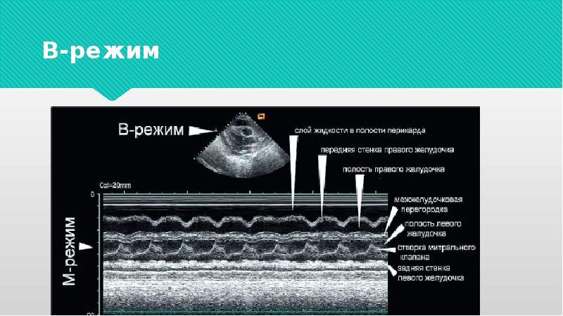 Режим б. М-режим ультразвукового исследования. ЭХОКГ М режим. Б режим ультразвукового исследования. А режим ультразвукового исследования.