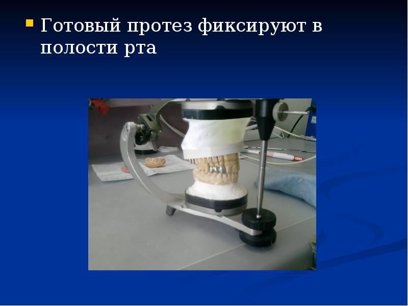 Готовый протез фиксируют в полости рта
Готовый протез фиксируют в полости Готовый протез фиксируют в полости рта
Готовый протез фиксируют в полости