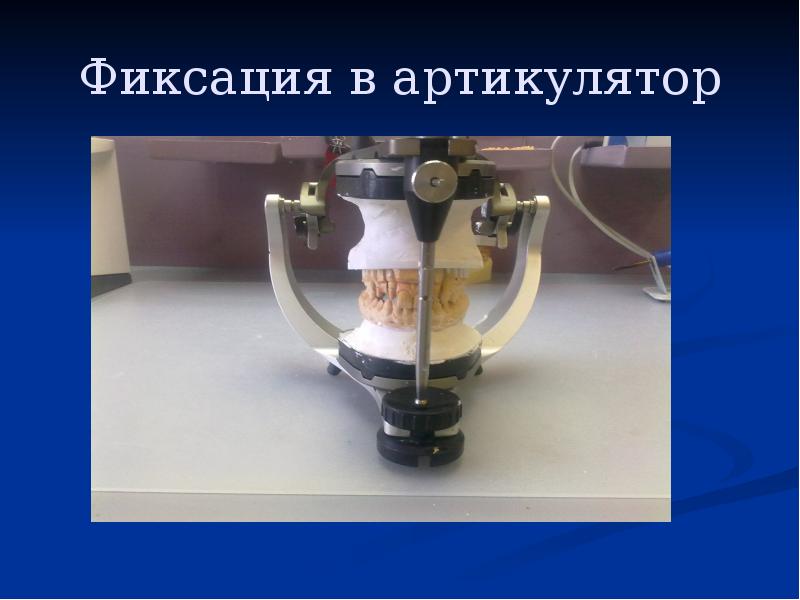 Фиксация в артикулятор Фиксация в артикулятор