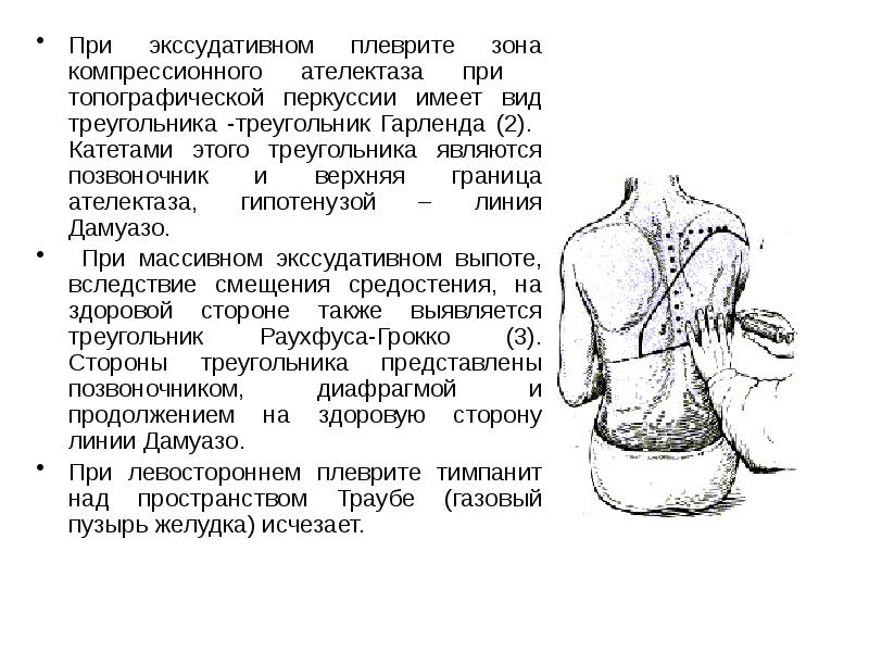 Перкуторная картина у больных с экссудативным плевритом