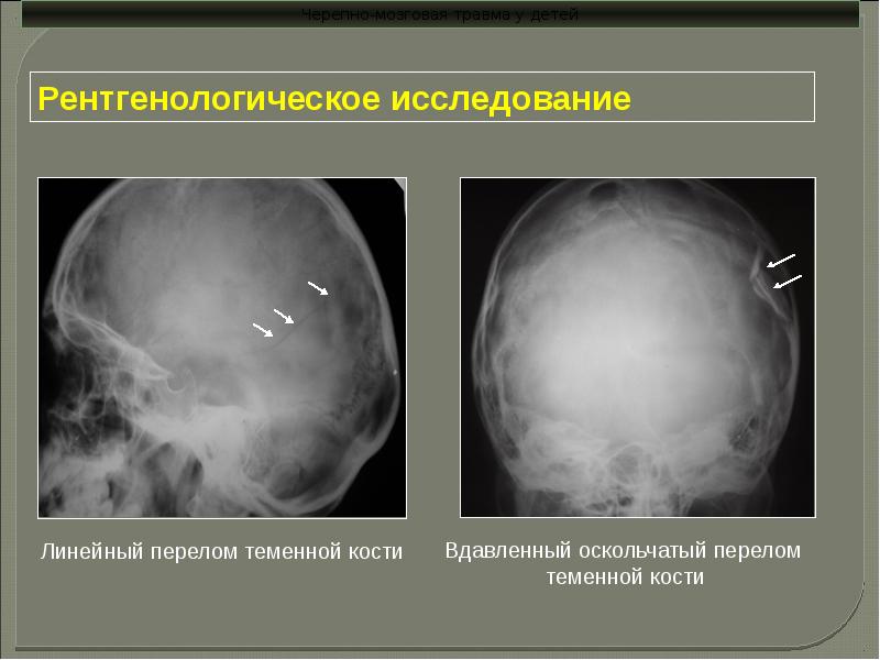 Чмт у детей презентация