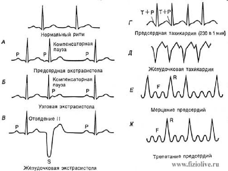 Мерцательная аритмия экг картинки