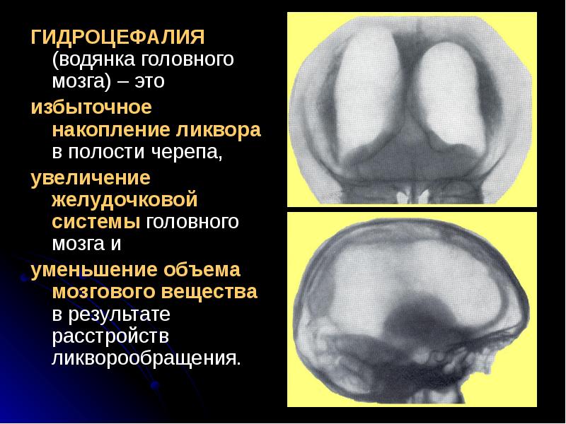 Гидроцефалия головного мозга презентация