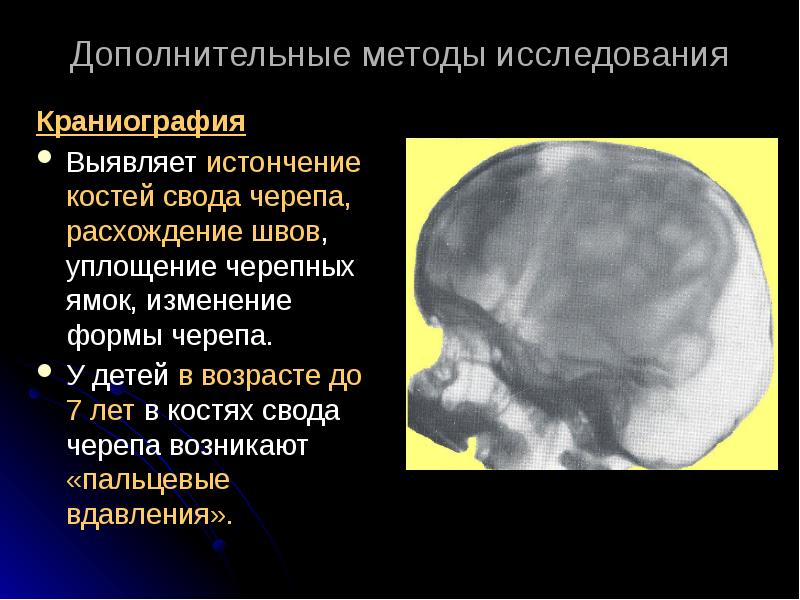 Усилен рисунок пальцевых вдавлений по всему своду черепа у ребенка