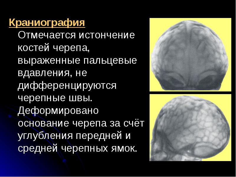 Усилен рисунок пальцевых вдавлений по всему своду черепа у ребенка