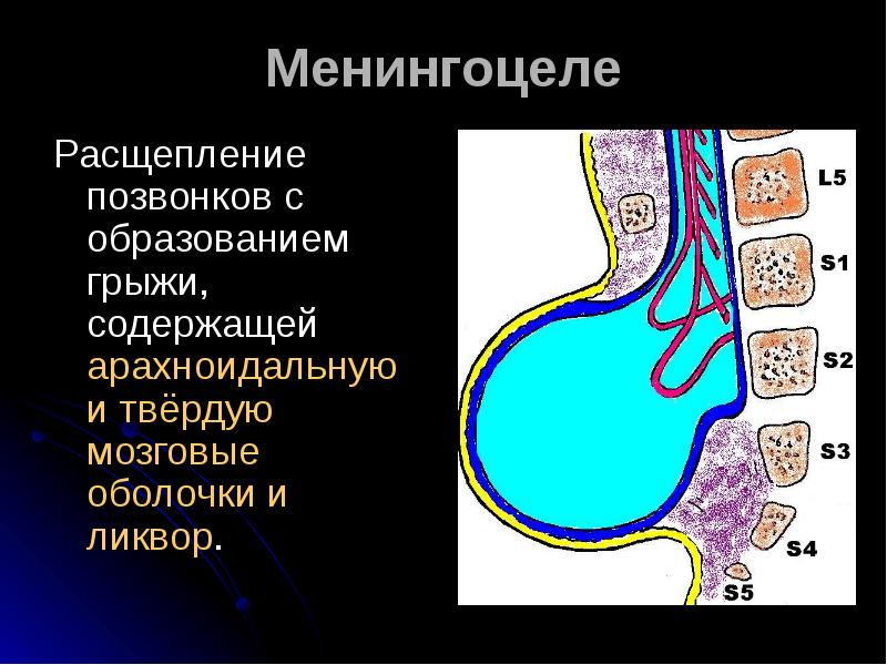 Презентация на тему расщепление позвоночника