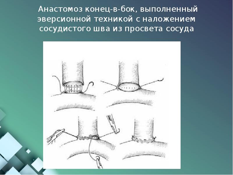 Анастомоз конец в конец схема