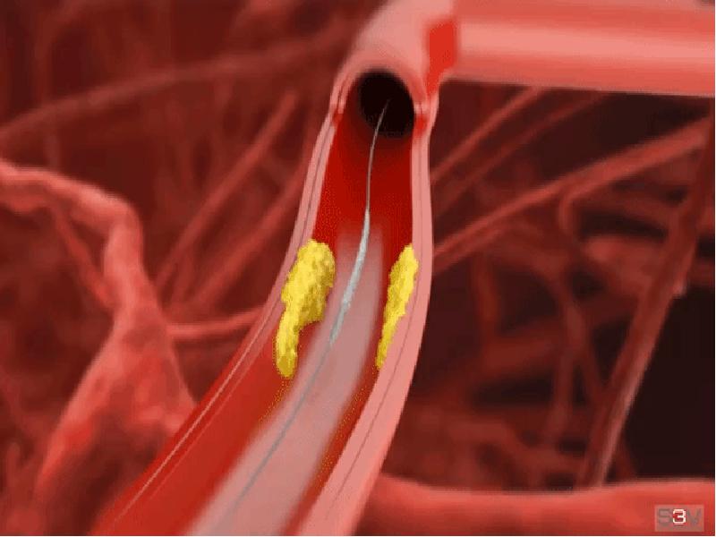 Стентирование сосудов сердца картинки