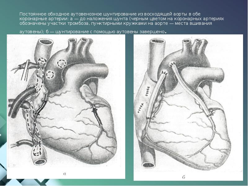 Аортокоронарное шунтирование схема операции