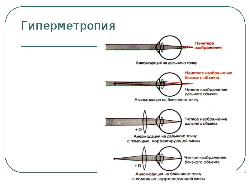 Гиперметропия. Гиперметропия классификация. Гиперметропия 1 степени что это такое. Гиперметропия средней степени. Гиперметропия обозначение.