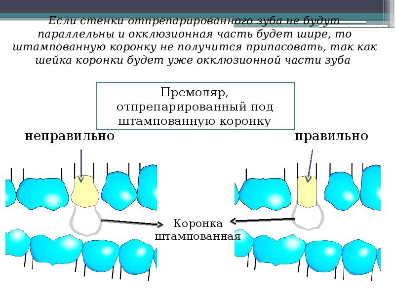 Штампованные коронки презентация