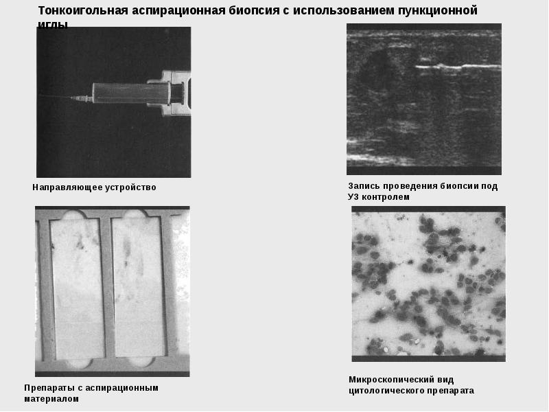 Тонкоигольная аспирационная биопсия щитовидной железы. Тонкоигольная аспирационная пункционная биопсия. Тонкоигольная аспирационная биопсия молочной. Тонкоигольная пункционная биопсия протокол. Тонкоигольная аспирационная биопсия цитологический атлас Домански.